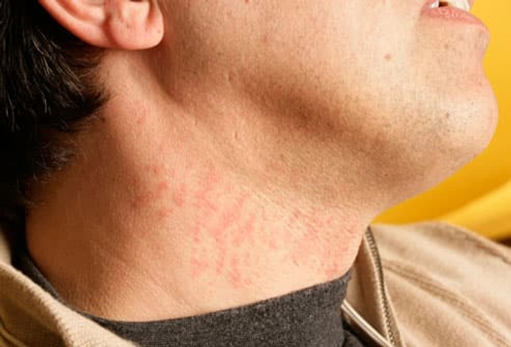 Razor Burn Razor Burn