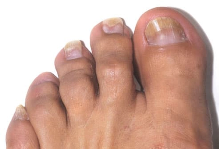Toenail Fungus