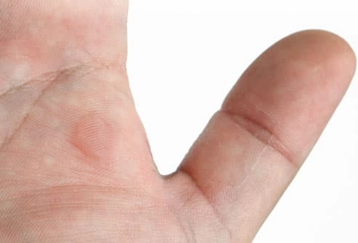 Blisters