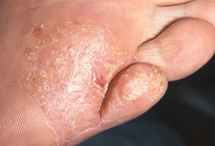Athlete's Foot