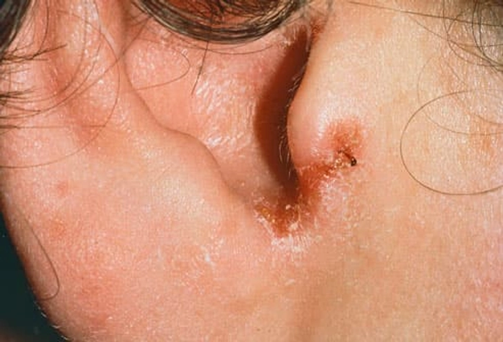 Swimmer's Ear