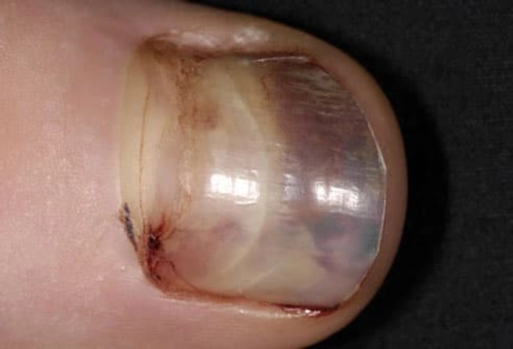 Runners' Black Toenail