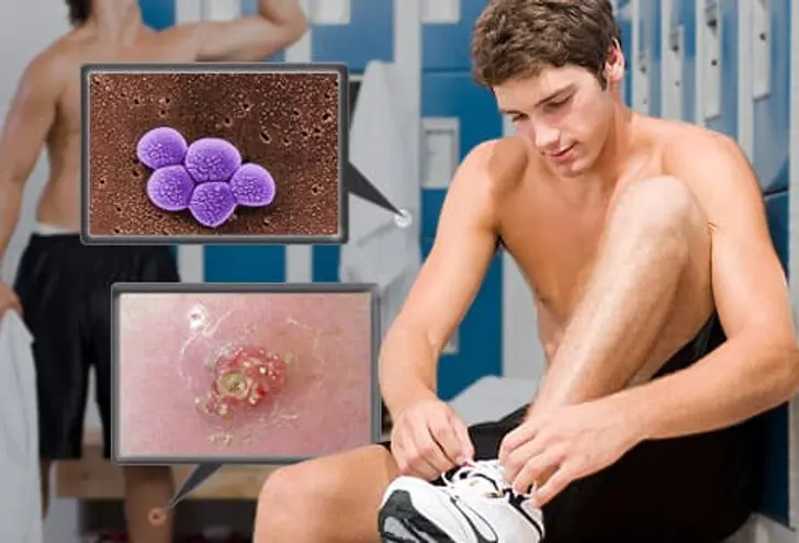 MRSA Skin Sores