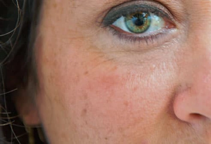 Fade Age Spots With Hydroquinone