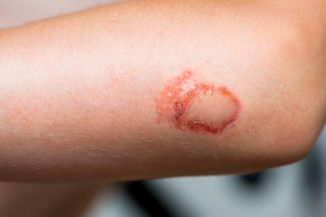 Carpet Burn Carpet Burn