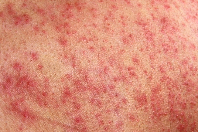 Allergic Reactions Allergic Reactions