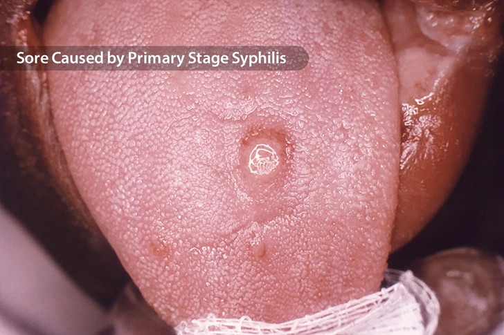 Sexually Transmitted Infection (STI) Sexually Transmitted Infection (STI)