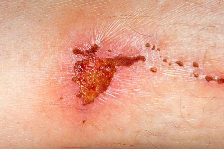 Related: Slow Wound Healing