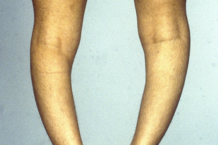 Related: Osteomalacia