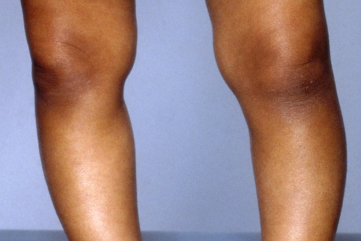 Related: Rickets