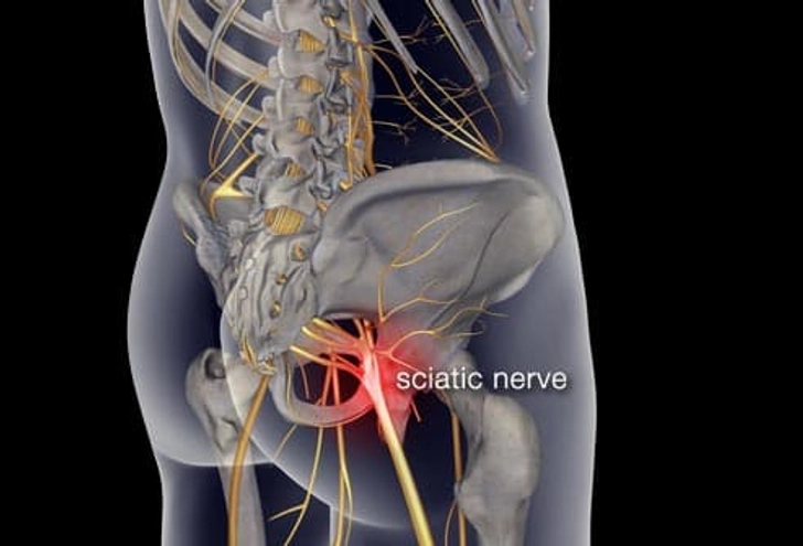 Muscle Strain or Sciatica? Muscle Strain or Sciatica?