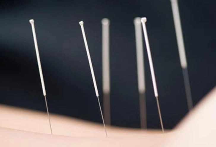 Acupuncture