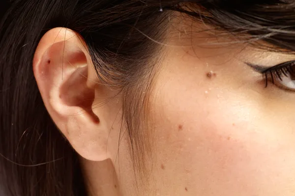 photo of moles on face