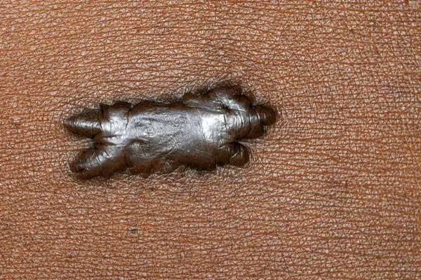 photo of keloid