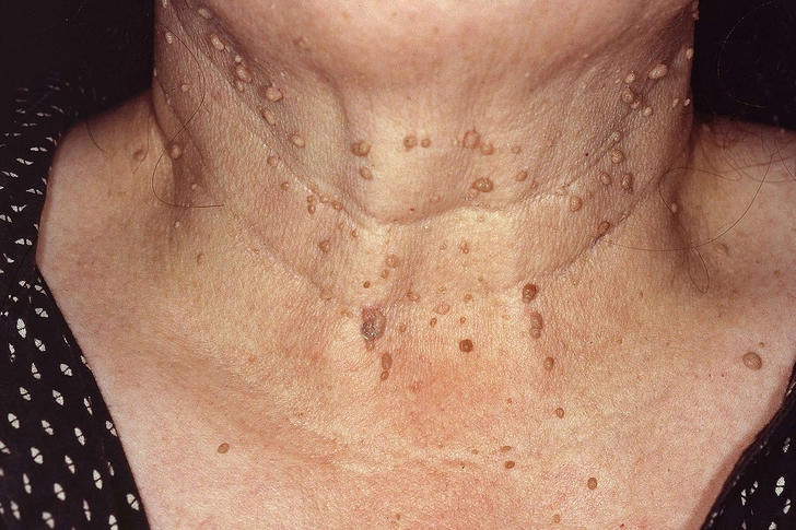 Skin Tags Skin Tags