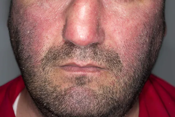 photo of atopic dermatitis on face
