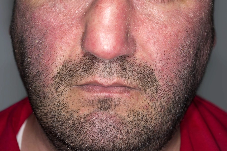 Atopic Dermatitis Atopic Dermatitis