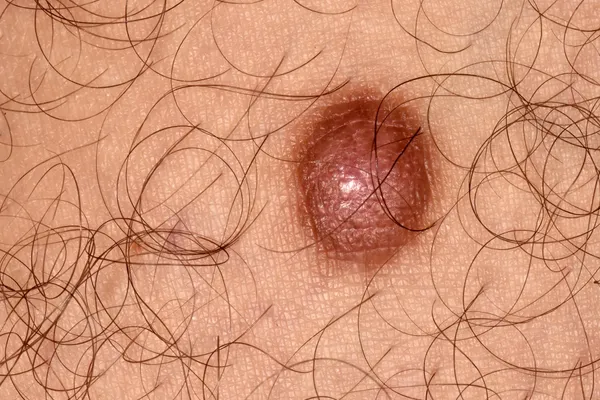 photo of dermatofibroma