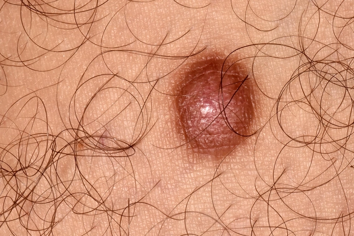 Dermatofibroma Dermatofibroma