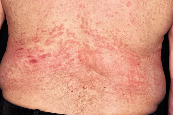 photo of hives on back