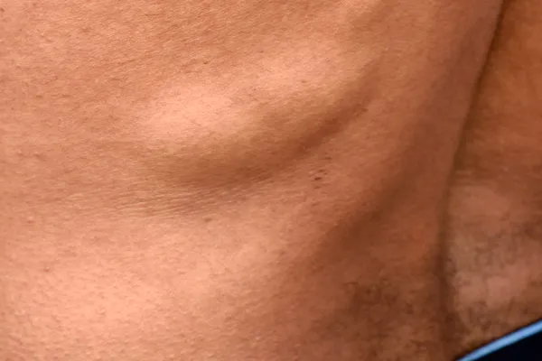 photo of lipoma on back