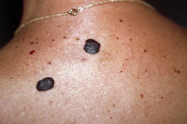 photo of seborrheic keratosis