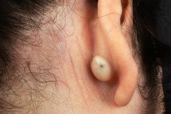 photo of skin cyst behind woman's ear