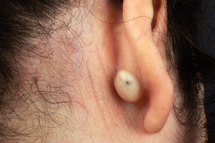 Skin Cysts Skin Cysts