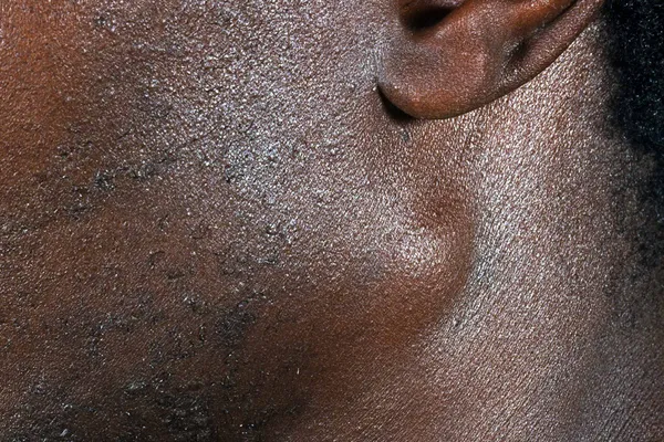 photo of swollen lymph node behind jaw