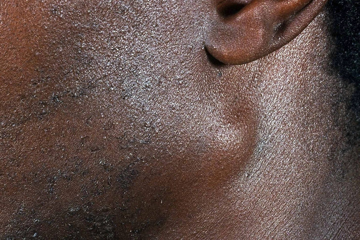 Swollen Lymph Nodes Swollen Lymph Nodes