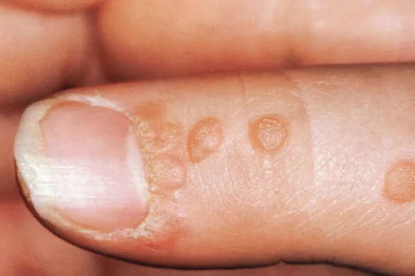 photo of warts on finger