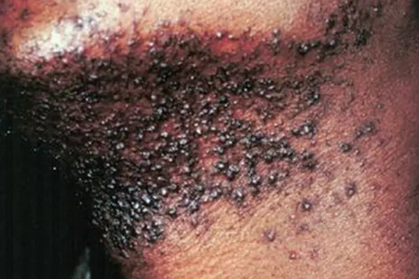photo of pseudofolliculitis barbae