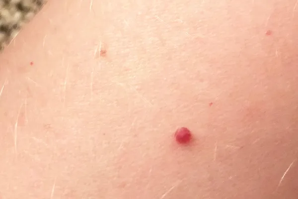 photo of cherry hemangioma
