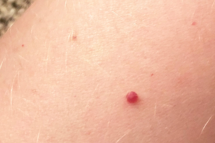 Cherry Hemangioma Cherry Hemangioma