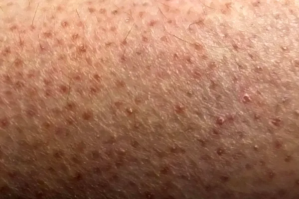 photo of keratosis pilaris