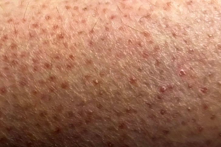 Keratosis Pilaris Keratosis Pilaris