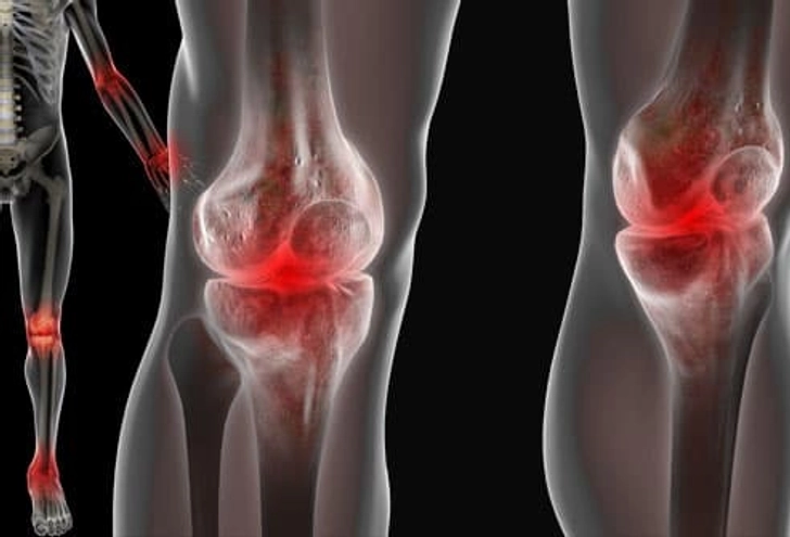 Lupus Symptom: Joint Pain Lupus Symptom: Joint Pain