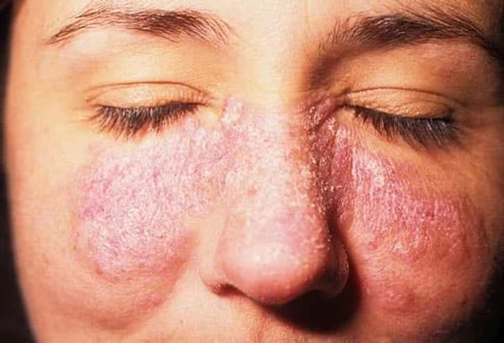 Lupus Symptom: Butterfly Rash Lupus Symptom: Butterfly Rash