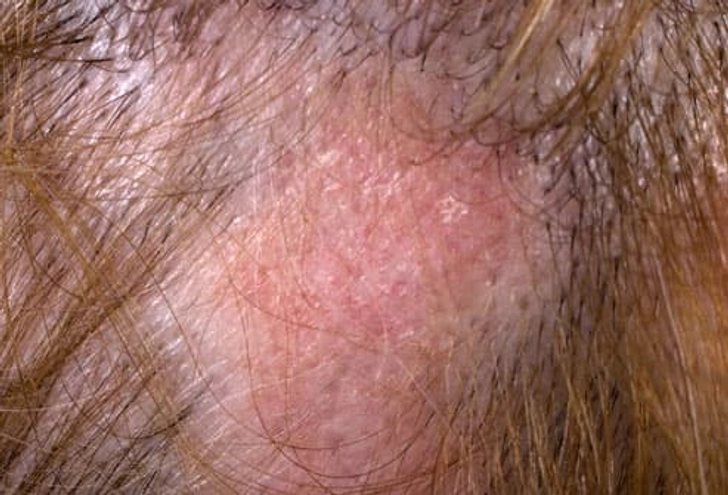 Lupus Symptom: Hair Loss Lupus Symptom: Hair Loss