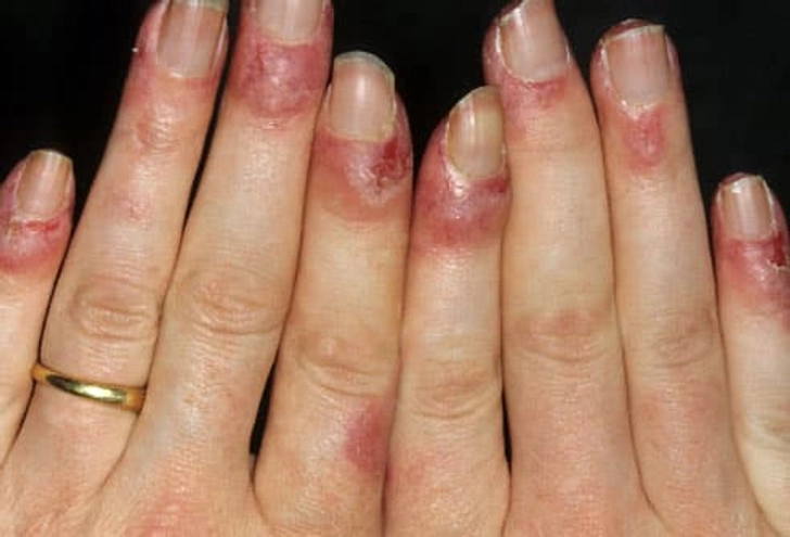 Lupus Symptom: Nail Changes Lupus Symptom: Nail Changes
