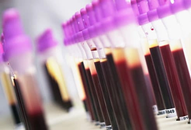 Diagnosing Lupus Diagnosing Lupus