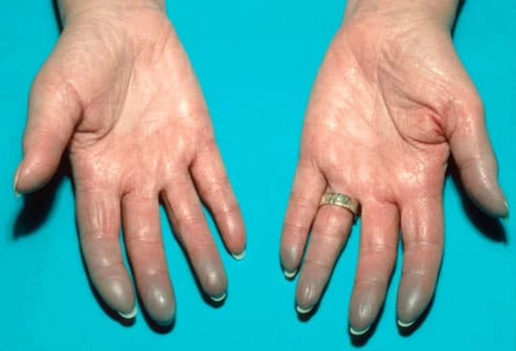 Lupus Symptom: Raynaud's Lupus Symptom: Raynaud's