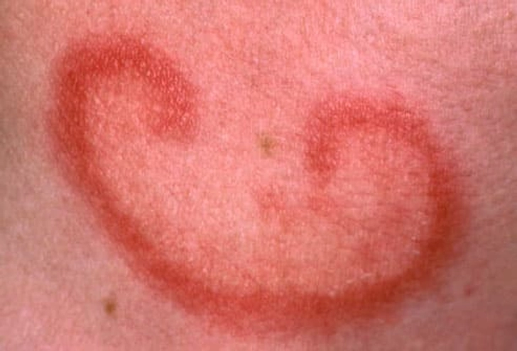 Types of Lupus Types of Lupus