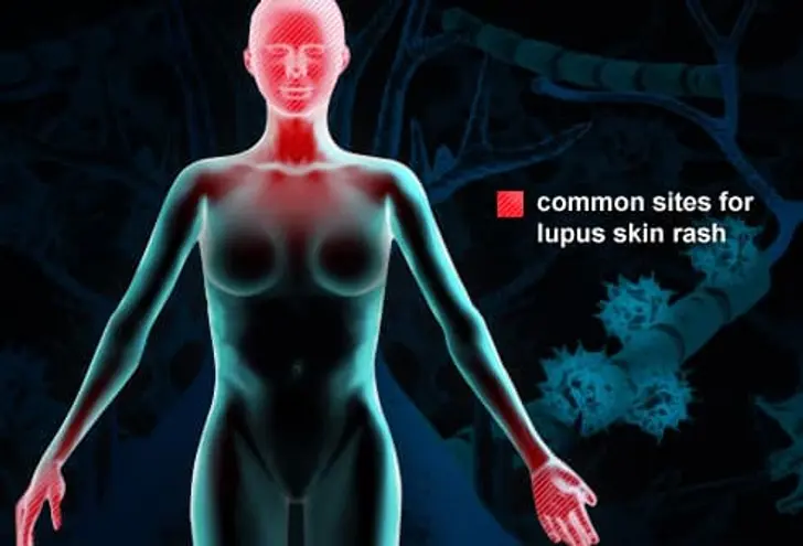 What Is Lupus? What Is Lupus?