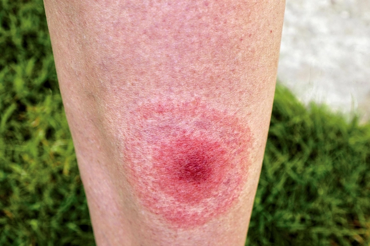 Symptoms: Early Stage