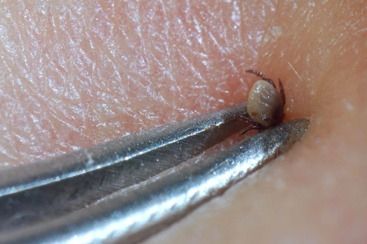 How to Remove a Tick How to Remove a Tick