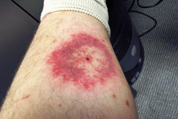 Lyme Disease-Like Illness