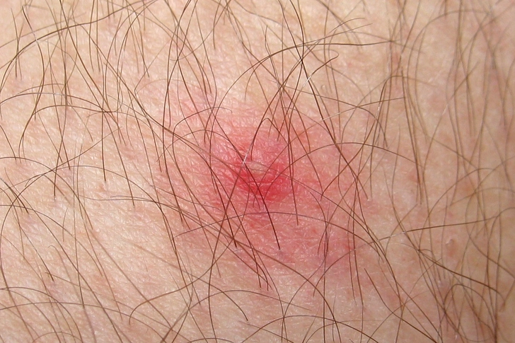 What’s NOT Lyme Disease
