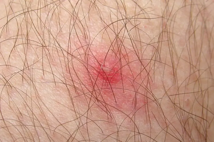 photo of tick bite