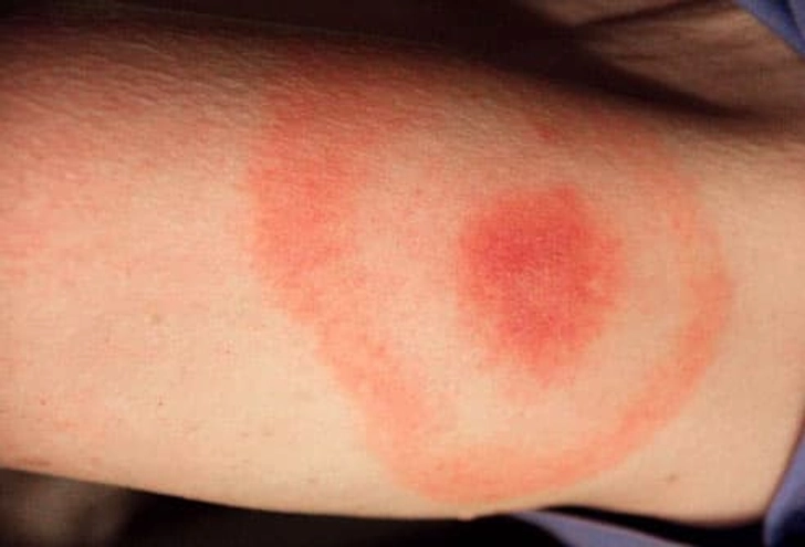 Lyme Disease Lyme Disease